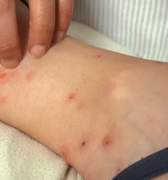 Bed Bug Bites Treatment Learn how to get rid of itchy bed bug bites fast