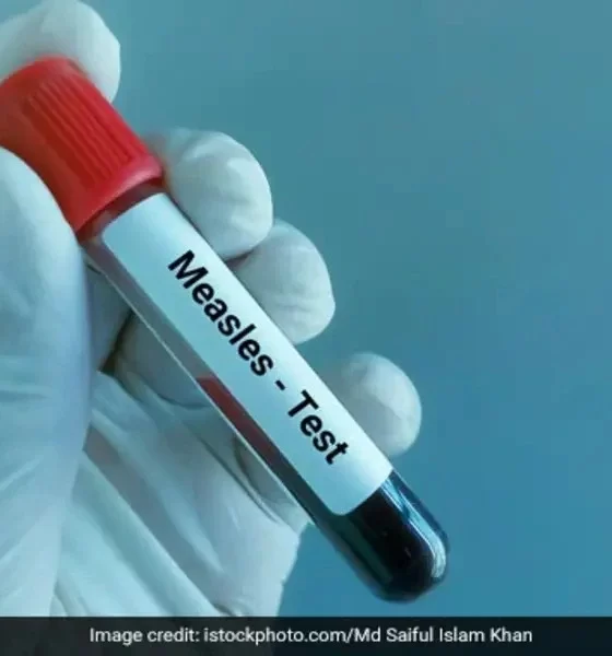 Measles: Symptoms, Prevention, And Treatment