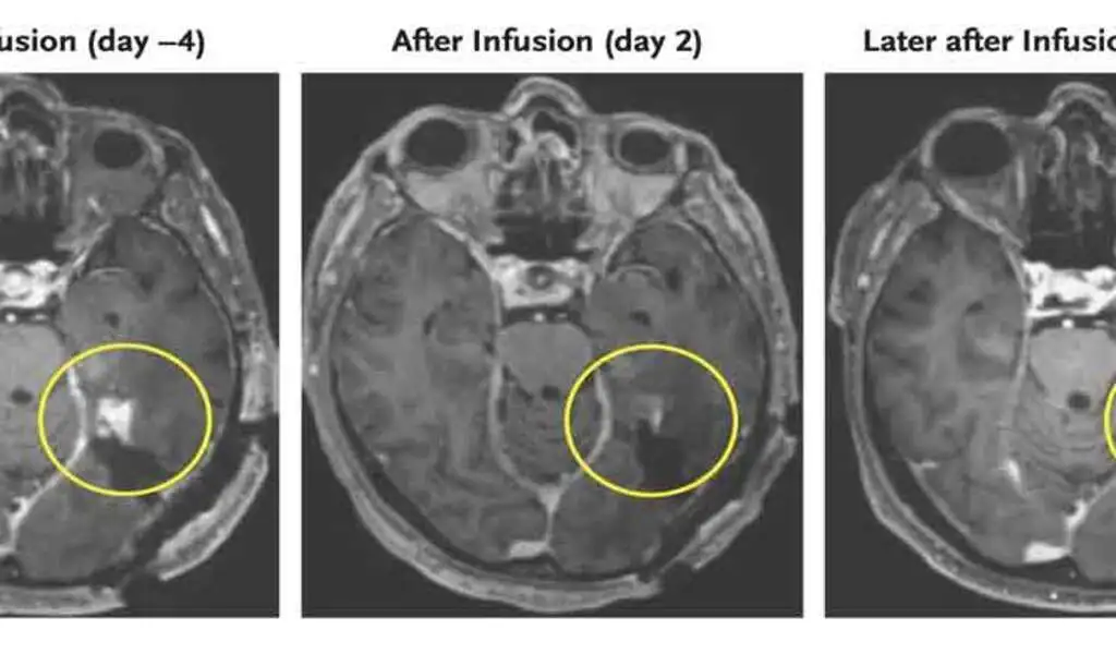 Brain Cancer Tumours Shrank in Early Tests With a New Strategy
