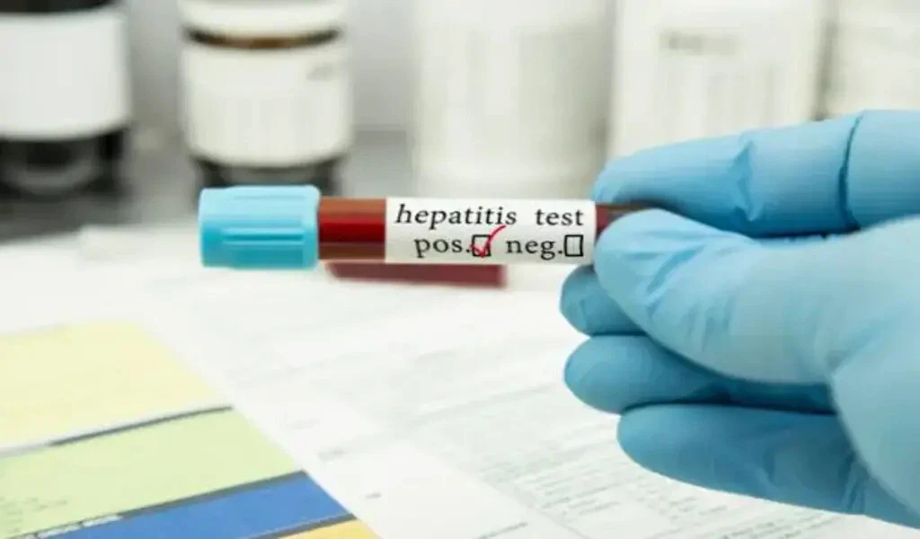 Hepatitis E