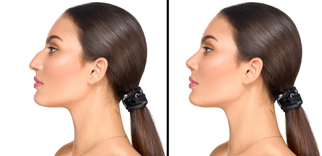 Rhinoplasty in Turkey
