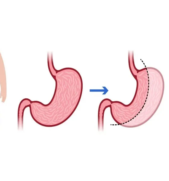 Whats Factors Influencing Gastric Sleeve Costs in Turkey