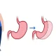 Whats Factors Influencing Gastric Sleeve Costs in Turkey